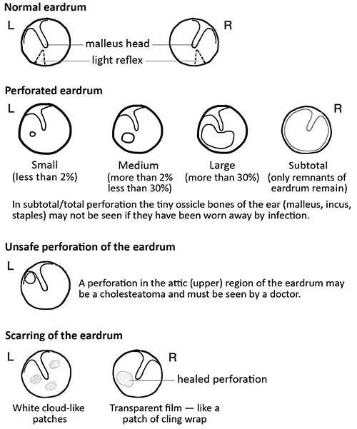 Tympanic Membrane Perforation Treatment Guidelines