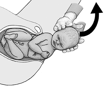 Zavanelli Maneuver Labour And Birth | RPHCM