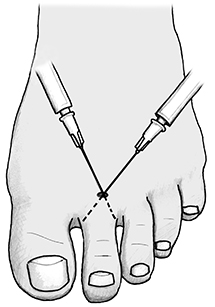 Nerve and ring blocks | RPHCM