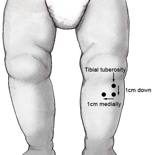 Putting in intraosseous needle | RPHCM