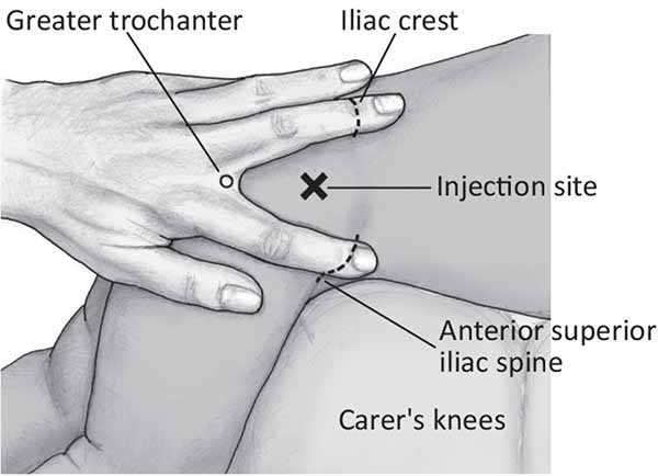 Intramuscular Injection Points